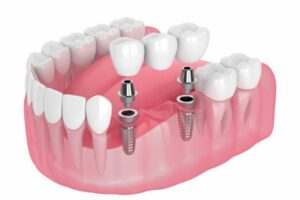 Dental Implants