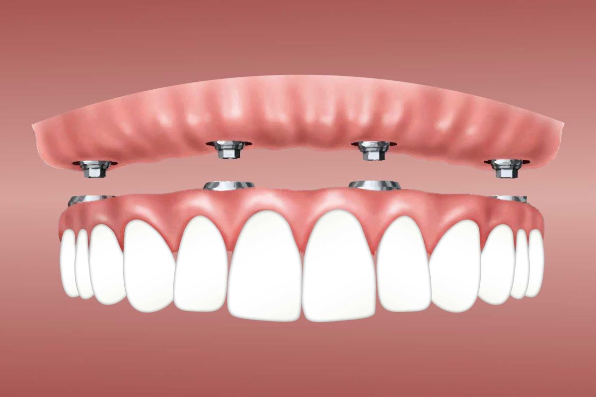 Dental Implants-02